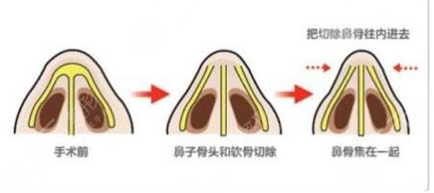 鹰钩鼻矫正
