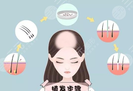 头顶植发