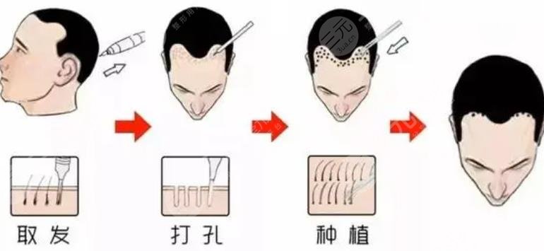 头顶植发