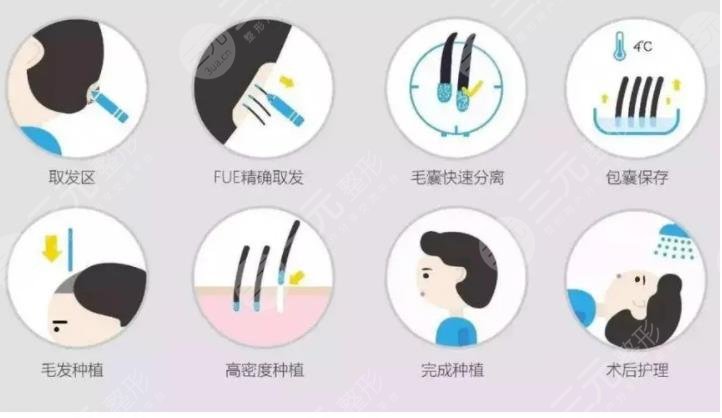 头发种植