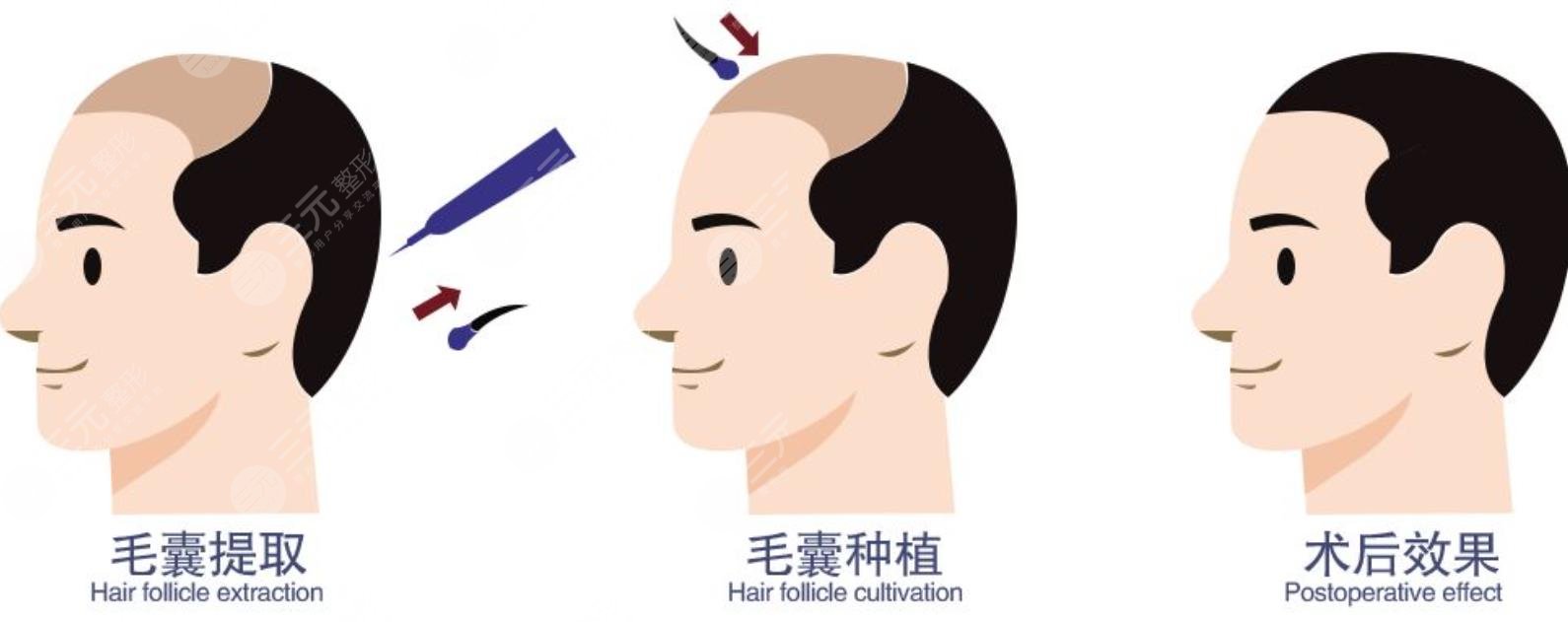 头发种植