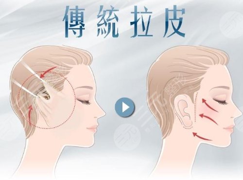 面部拉皮手术提升果和视频