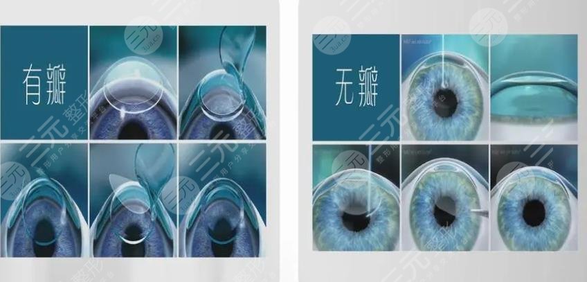 广州华侨医院近视手术项目科普