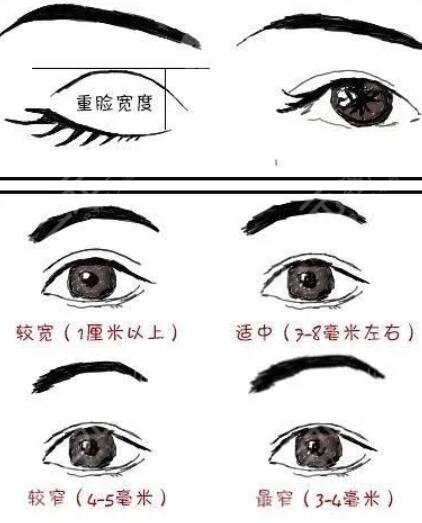 双眼皮二次修复