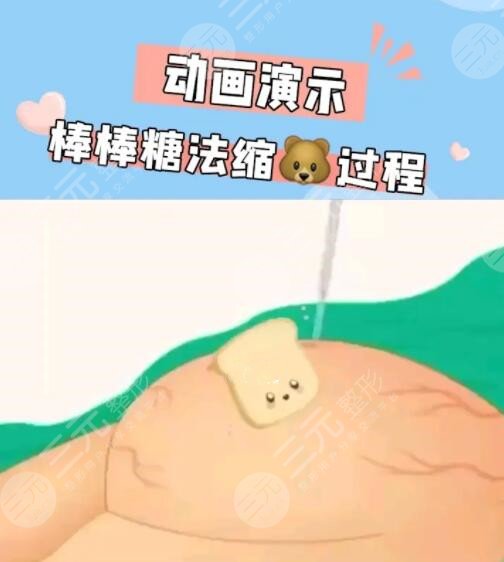 缩胸手术