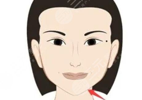 玻尿酸下巴填充