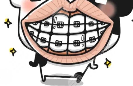 牙套
