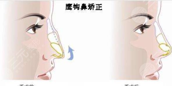 鹰钩鼻