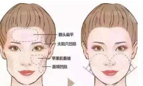 自体脂肪填充面部