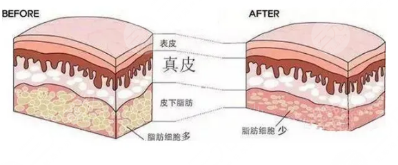 腹部抽脂术后需要修复几天？优点&弊端&注意事项超全盘点！