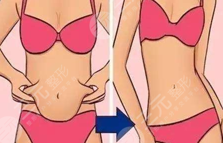 腹部抽脂手术的优点都有哪些?