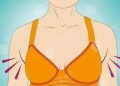 胸部抽脂多少钱？吸脂缩胸手术科普来咯，附术后注意事项~