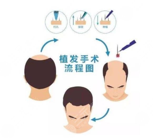 深圳北大医院植发科室擅长项目