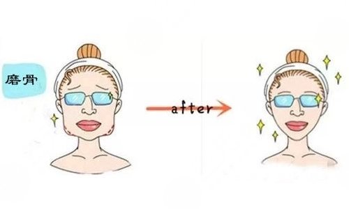 下颌角整形术有危险吗?