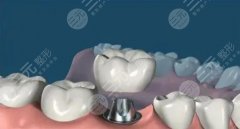 半口种植牙全过程步骤讲解！果如何， 术后怎样护理，超全知识！