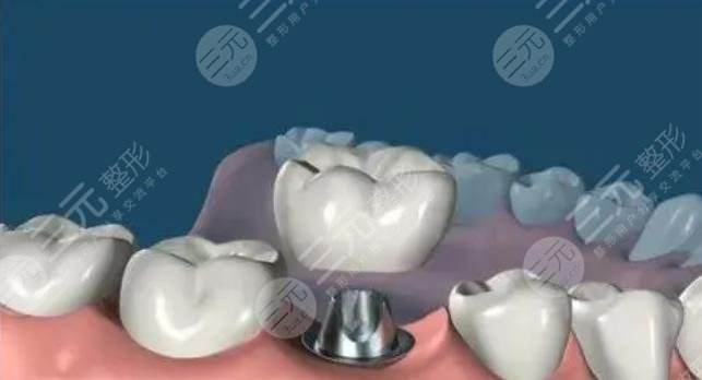 牙齿种植