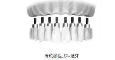 牙齿种植
