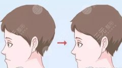 下颌前突手术截骨部位是哪？地包天正颌手术科普，掌握知识心不慌！