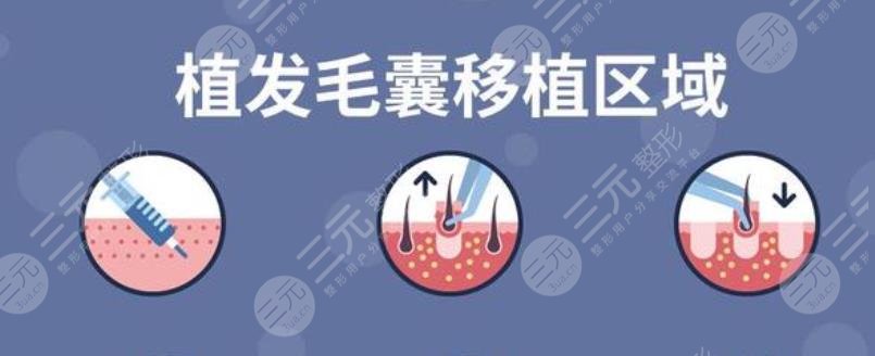 头发移植