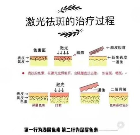 激光祛斑