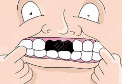 半口种植牙什么意思，适合哪些情况？科普分享牙齿修复新选择！