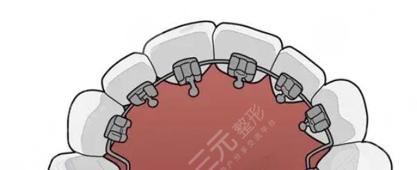 舌侧丝