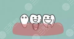 全口种植牙有几种方式，能用多久？科普缺牙的修复指南，重铸好牙口！