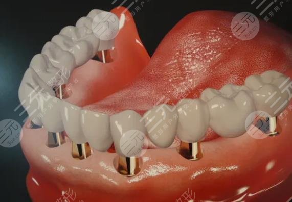 全口种植牙