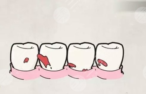根管缓解