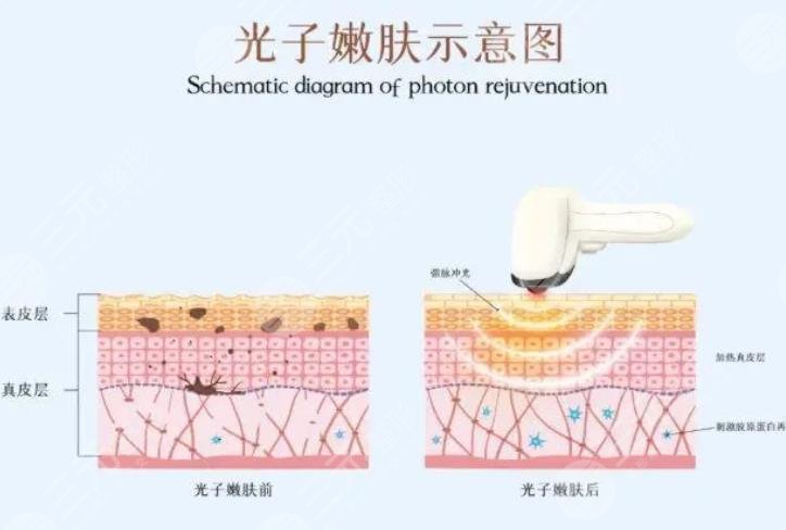 激光去痣的原理和优势
