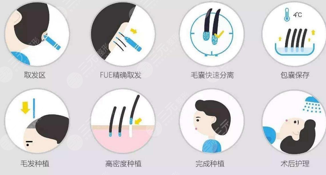 武汉协和医院植发科开展项目