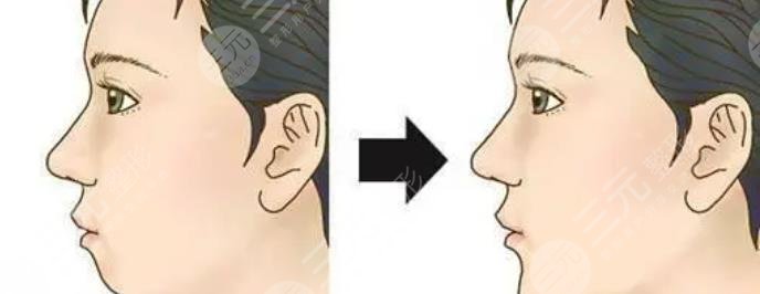 凸嘴手术