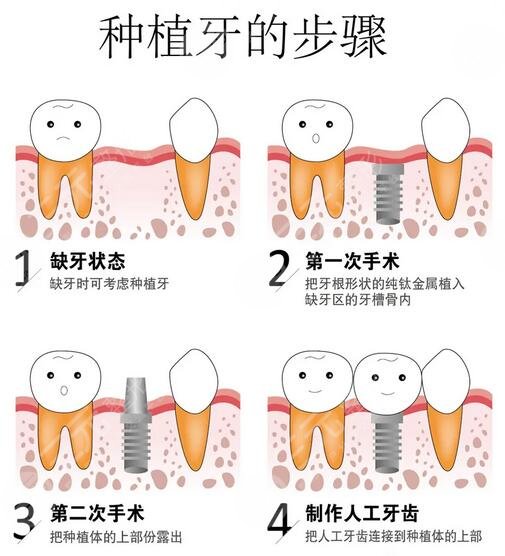 种植牙原理图