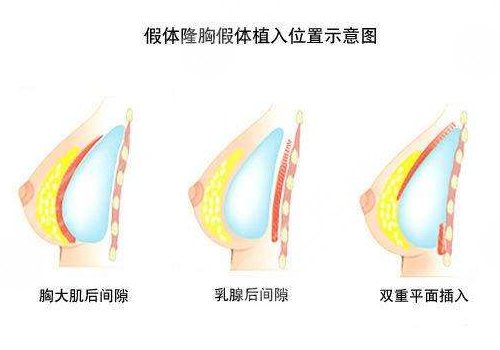 隆胸术后护理知识注意