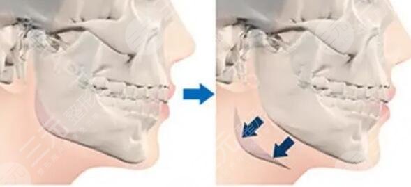 下颌角整形手术要注意什么?