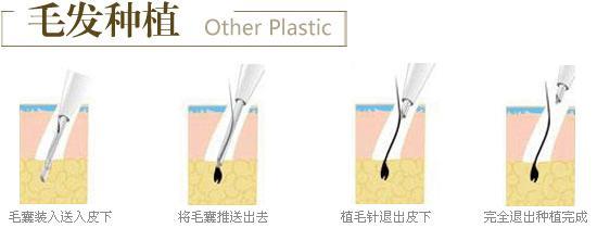 私密种植是什么意思？毛发移植原理&价格分享，附手术注意事项！