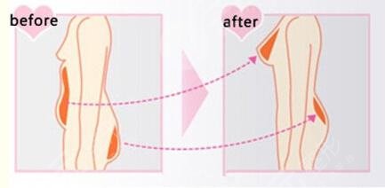 吸脂填胸后要注意什么?这4件事不能忘!恢复期常识科普~ 吸脂填胸后要注意什么?这4件事不能忘!恢复期常识科普~