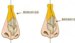 歪鼻矫正后还会反弹吗？术后如何护理？科普！这4件事牢记~