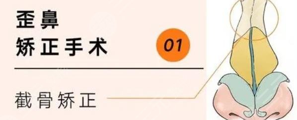 歪鼻矫正