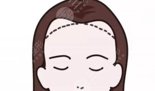 发际线