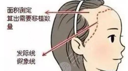 发际线