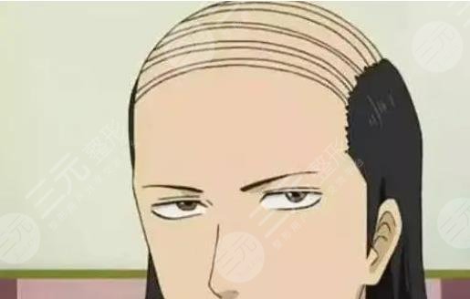 发际线