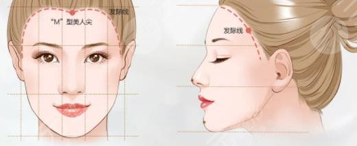 发际线