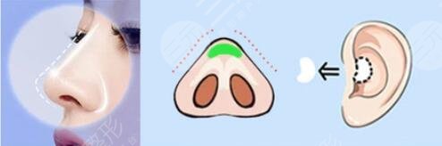 注射隆鼻手术