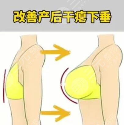 隆胸手术