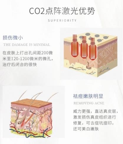 广州华侨医院激光祛斑案例分享