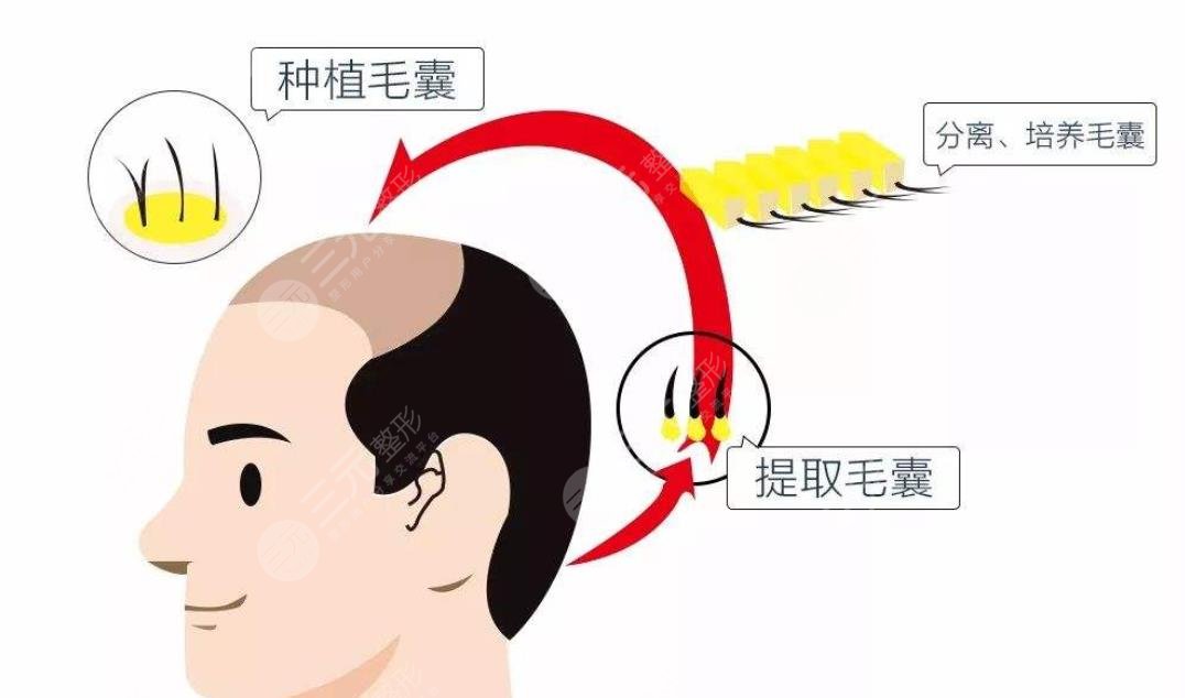 南方医院发际线植发案例