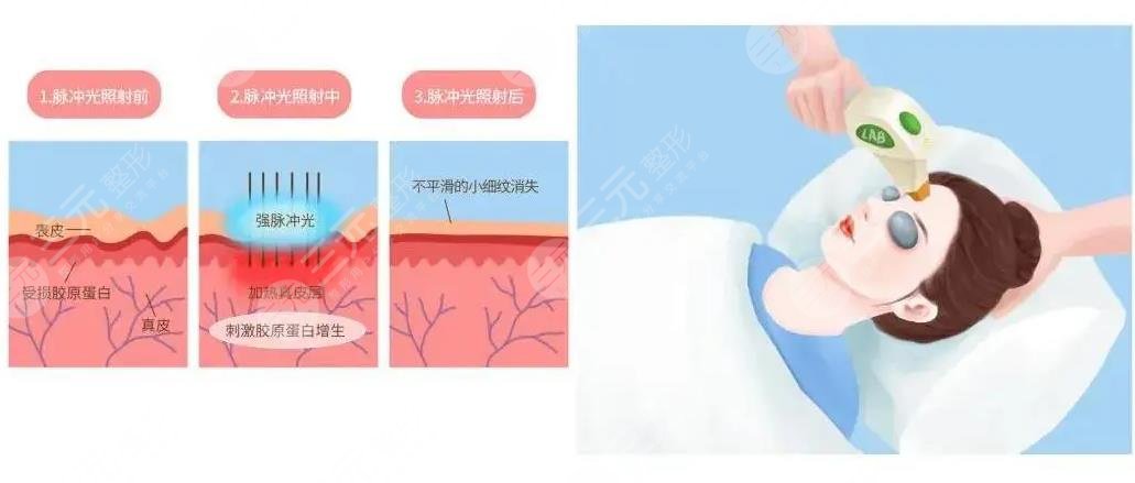 中山三院光子嫩肤案例