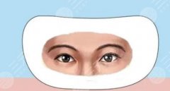 种眉毛是*的吗，果好不好？手术原理+注意事项，术前必看！