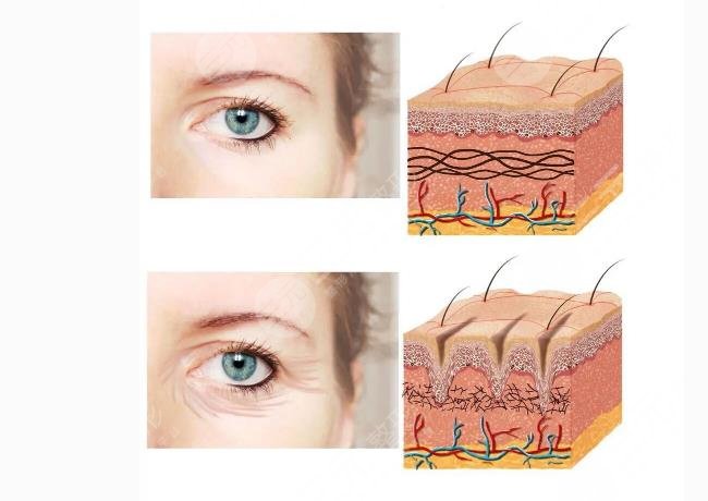 眼袋手术1--10天图片:恢复期之后眼周肌肤紧致许多！"眼值"高高~